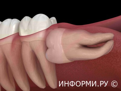 Рекомендации после удаления зуба мудрости