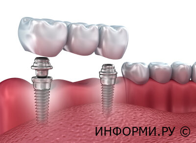 Протезирование на имплантах: важные моменты