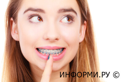 Зачем нужно ставить брекеты?