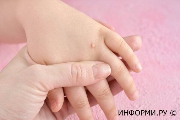 Бородавки: причины появления, опасность, способы лечения