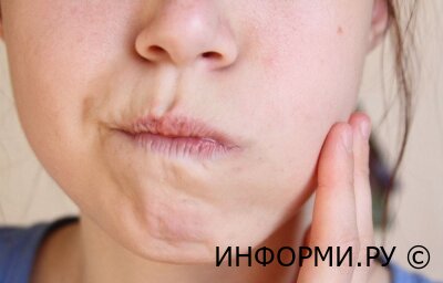 Что такое флюс и чем он опасен?