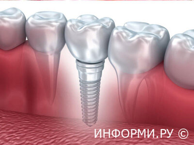 Чем хороши зубные импланты Нобель?
